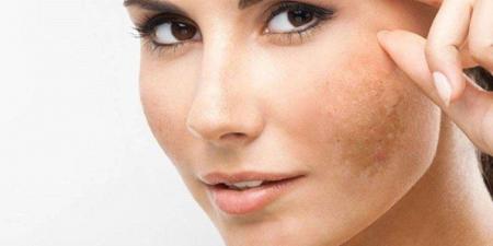 مع
      ارتفاع
      درجات
      الحرارة..
      كيف
      تحمي
      نفسك
      من
      البقع
      الشمسية؟ - تكنو بلس