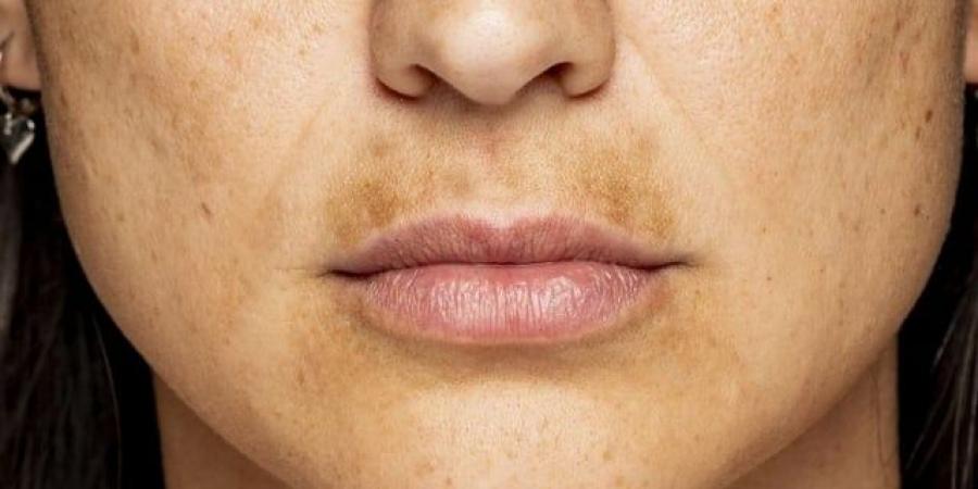 بشرة خالية من البقع: حل التصبغات بعد إزالة الشعر بالشمع - تكنو بلس