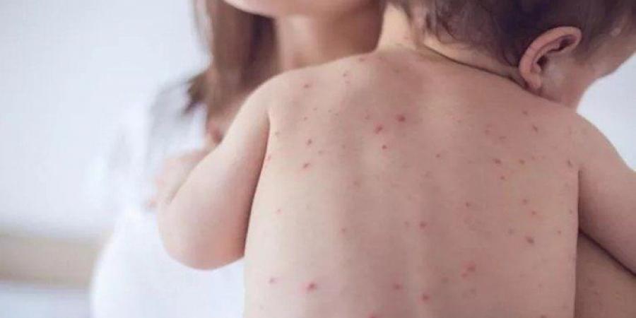 انتهاء
      حالات
      تفشي
      الحصبة
      في
      ولايتي
      "ميشيجان"
      و"بنسلفانيا"
      الأمريكيتين - تكنو بلس